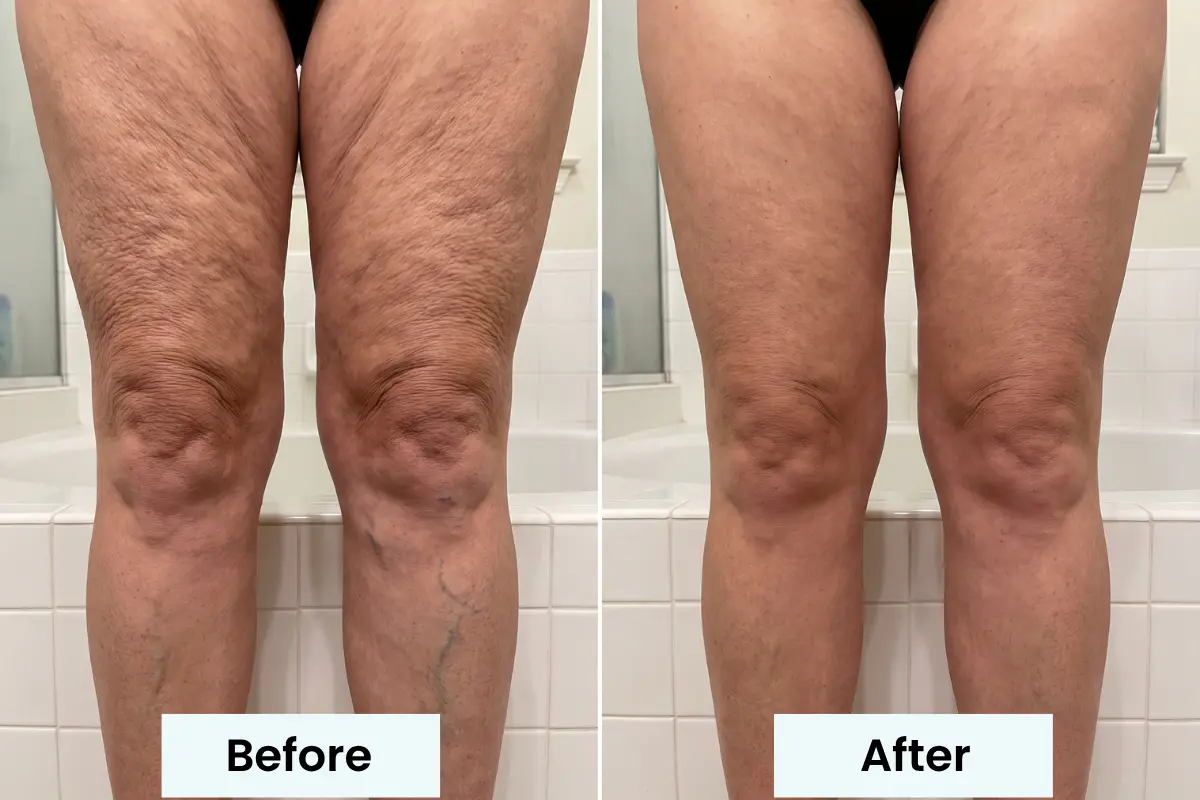 Before and after photo of a woman's legs: crepey folds over the knees on the left, smoother skin on the right