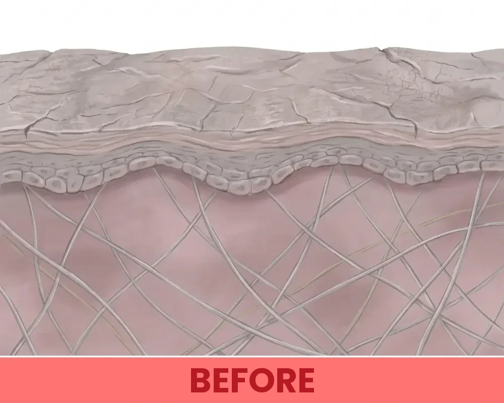 Before: the starved, collapsed collagen mesh under post-weight-loss leg skin